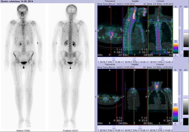 Obr..3: Celotlov scintigrafie v pedn a zadn projekci a fze obraz SPECT a CT.  Vpravo nahoe zameno na loisko v obratli na pechodu krn a hrudn ptee, vpravo dole na acromion lev lopatky. ezy transverzln, ezy sagitln a ezy koronrn.