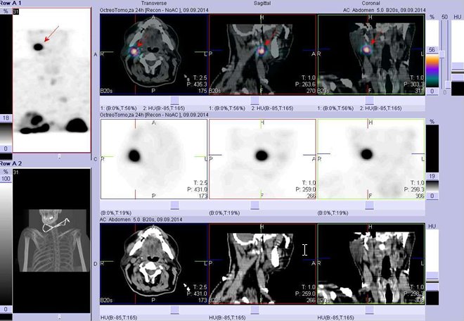 Obr. č. 8: Fúze obrazů SPECT a CT. Vyšetření 24 hod. po aplikaci radioindikátoru. Zaměřeno na ložisko v krční uzlině vpravo.