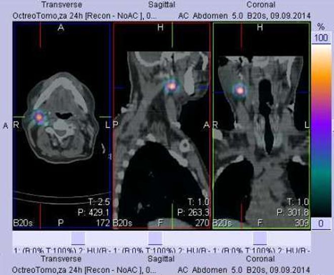 Obr. č. 9: Fúze obrazů SPECT a CT. Vyšetření 24 hod. po aplikaci radioindikátoru. Zaměřeno na ložisko v krční uzlině vpravo.