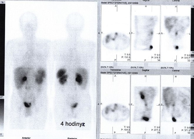 Obr.1: Celotělová scintigrafie v přední a zadní projekci a tomografická scintigrafie břicha a pánve 4 hod. po aplikaci OctreoScanu.