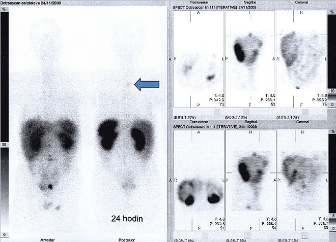 Obr.3: Celotělová scintigrafie v přední a zadní projekci a tomografická scintigrafie břicha a pánve 24 hod. po aplikaci OctreoScanu.