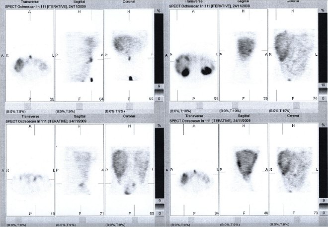 Obr. č. 4: Tomografická scintigrafie (SPECT) břicha a pánve 24 hod. po aplikaci OctreoScanu.