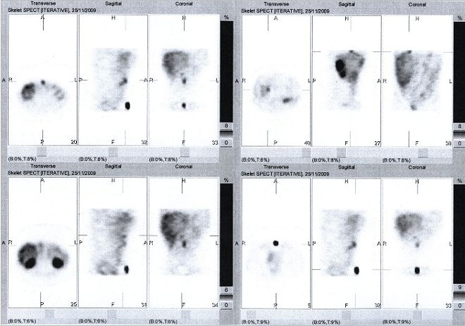 Obr. č. 6: Tomografická scintigrafie (SPECT) břicha a pánve 48 hod. po aplikaci OctreoScanu.