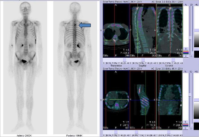 Obr. č. 7: Celotělová scintigrafie v přední a zadní projekci a fúze obrazů SPECT a CT.