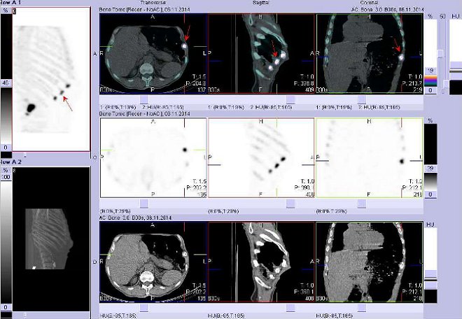 Obr. č. 8: Fúze obrazů SPECT a CT. Zaměřeno na ložisko v laterální části 10. žebra vlevo.