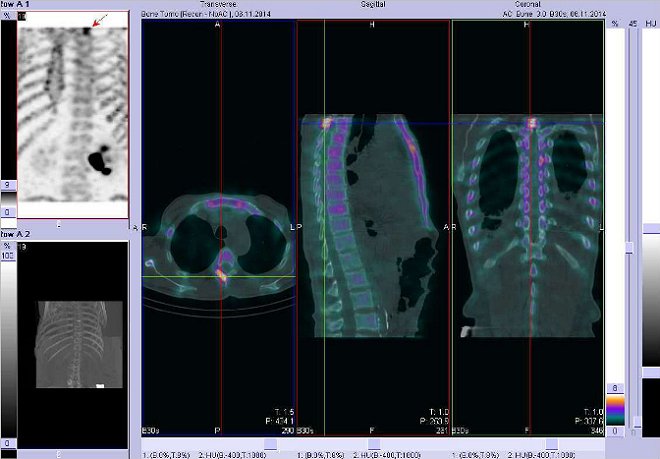 Obr. č. 9: Fúze obrazů SPECT a CT.