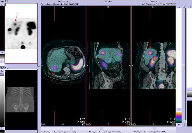 Obr.3: Fúze obrazů SPECT a CT. Zaměřeno na ložisko v pravém jaterním laloku. Řez transverzální, sagitální a koronární. Vyšetření 4 hod. po aplikaci OctreoScanu.
