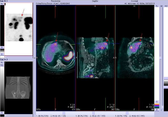 Obr. č. 5: Fúze obrazů SPECT a CT. Zaměřeno na ložisko v levém jaterním laloku. Řez transverzální, sagitální a koronární. Vyšetření 4 hod. po aplikaci OctreoScanu.