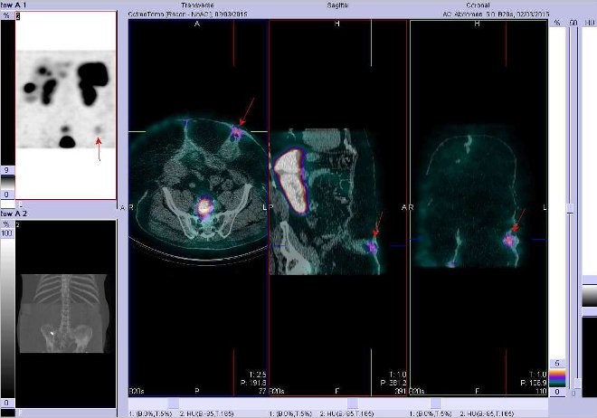 Obr. č. 8: Fúze obrazů SPECT a CT. Zaměřeno na aktivitu ve střevní kličce (nejedná se o patologický nález). Řez transverzální, sagitální a koronární. Vyšetření 4 hod. po aplikaci OctreoScanu.