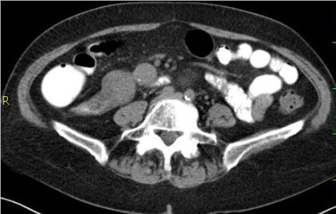 Obr. č. 2: CT břicha a pánve, řez transverzální.