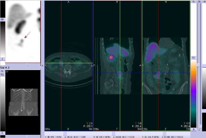 Obr. č. 5: Fúze obrazů SPECT a CT. Zaměřeno na ložisko v pravém mesogastriu. Řez transverzální, sagitální a koronární. Vyšetření 24 hod. po aplikaci OctreoScanu.