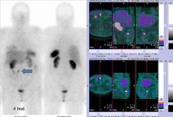 Obr..1: Celotlov scintigrafie vpedn a zadn projekci a fze SPECT/CT 4 hod. po aplikaci OctreoScanu. Zameno na loiska vpravm mesogastriu, loisko vpravo nahoe odpovd stevn klice, loisko vpravo dole je zejm tumorem ve stev.