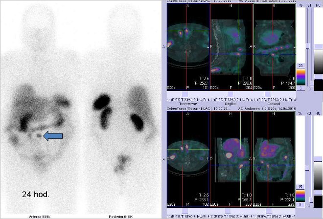 Obr. . 2: Celotlov scintigrafie vpedn a zadn projekci a fze SPECT/CT 24 hod. po aplikaci OctreoScanu. Zameno na loiska vpravm mesogastriu, loisko vpravo dole odpovd stevn klice, loisko vpravo nahoe je zejm tumorem ve stev.