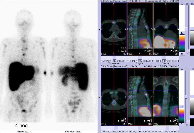 Obr.č.1: Celotělová scintigrafie v přední a zadní projekci a fúze SPECT/CT 4 hod. po aplikaci OctreoScanu. Zaměřeno na ložiska ve skeletu – ve sternu a obratli.