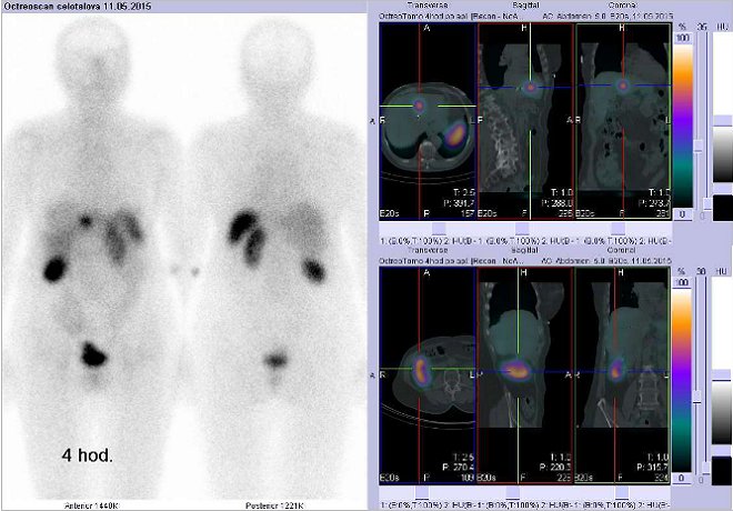 Obr. č. 1: Celotělová scintigrafie v přední a zadní projekci a fúze SPECT/CT 4 hod. po aplikaci OctreoScanu. Nahoře vpravo zaměřeno na ložisko ve ventrální části jater na rozhraní pravého a levého laloku. Dole vpravo zaměřeno na pravou ledvinu.