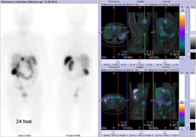 Obr. č. 2: Celotělová scintigrafie v přední a zadní projekci a fúze SPECT/CT 24 hod. po aplikaci OctreoScanu. Nahoře vpravo zaměřeno na ložisko ve ventrální části jater na rozhraní pravého a levého laloku. Dole vpravo zaměřeno na levou část příčného tračníku.