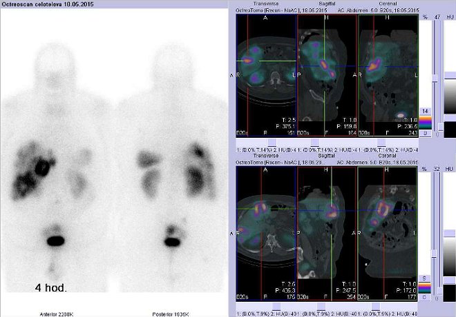 Obr. č. 4: Celotělová scintigrafie a fúze obrazů SPECT a CT – vyšetření břicha. Vyšetření 4 hod. po aplikaci radiofarmaka. Vždy nad sebou: vlevo transverzální řezy, uprostřed sagitální řezy, vpravo koronární. Vpravo nahoře a dole zaměřeno na ložiska v játrech.