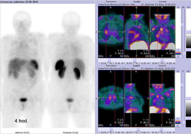 Obr.č.2: Celotělová scintigrafie a fúze obrazů SPECT a CT – vyšetření hrudníku. Vyšetření 4 hod. po aplikaci radiofarmaka. Vždy nad sebou: vlevo transverzální řezy, uprostřed sagitální, vpravo koronární. Vpravo nahoře a dole zaměřeno na ložiska v plicích a mediastinu.