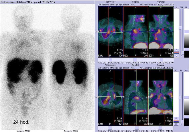 Obr. č. 4: Celotělová scintigrafie a fúze obrazů SPECT a CT – vyšetření hrudníku. Vyšetření 24 hod. po aplikaci radiofarmaka. Vždy nad sebou: vlevo transverzální řezy, uprostřed sagitální, vpravo koronární. Vpravo nahoře a dole zaměřeno na ložiska v mediastinu.