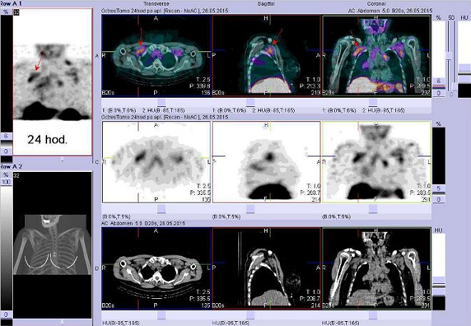 Obr. č. 5: Fúze obrazů SPECT a CT – vyšetření hrudníku a krku. Vyšetření 24 hod. po aplikaci radiofarmaka. Nahoře fúze obrazů, uprostřed SPECT, dole CT. Vždy nad sebou: vlevo transverzální řezy, uprostřed sagitální, vpravo koronární. Zaměřeno na uzliny v pravé axile.
