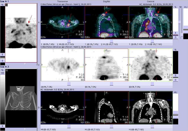 Obr. č. 6: Fúze obrazů SPECT a CT – vyšetření hrudníku a krku. Vyšetření 24 hod. po aplikaci radiofarmaka. Nahoře fúze obrazů, uprostřed SPECT, dole CT. Vždy nad sebou: vlevo transverzální řezy, uprostřed sagitální, vpravo koronární. Zaměřeno na uzliny na krku vlevo.