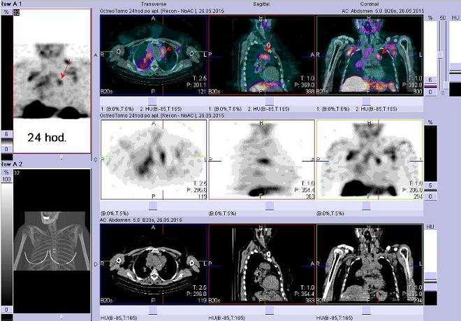 Obr. č. 7: Fúze obrazů SPECT a CT – vyšetření hrudníku a krku. Vyšetření 24 hod. po aplikaci radiofarmaka. Nahoře fúze obrazů, uprostřed SPECT, dole CT. Vždy nad sebou: vlevo transverzální řezy, uprostřed sagitální, vpravo koronární. Zaměřeno na uzliny v levém plicním hilu.