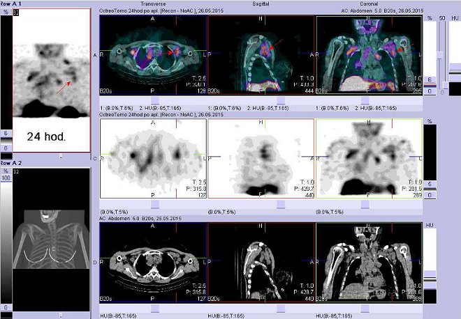 Obr. č. 8: Fúze obrazů SPECT a CT – vyšetření hrudníku a krku. Vyšetření 24 hod. po aplikaci radiofarmaka. Nahoře fúze obrazů, uprostřed SPECT, dole CT. Vždy nad sebou: vlevo transverzální řezy, uprostřed sagitální, vpravo koronární. Zaměřeno na uzliny v levé axile.