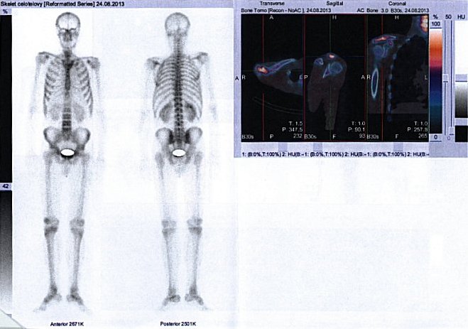 Obr.1: Scintigrafie skeletu. Celotělová scintigrafie v přední a zadní projekci a fúze obrazů SPECT a CT se zaměřením na hrudník.