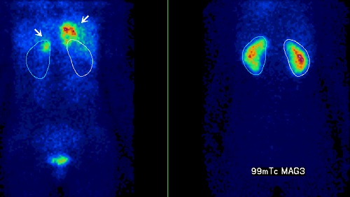 Snímek s 99mTc MAG a vymezení ROI ledvin na snímku s 123I MIBG