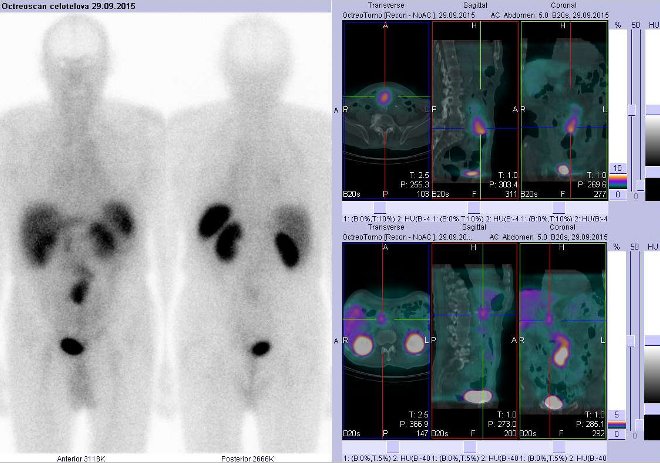 Obr.č.1: Celotělová scintigrafie v přední a zadní projekci a fúze obrazů SPECT a CT. Vyšetření 4 hod. po aplikaci radioindikátoru. Zaměřeno na vysoce aktivní ložisko ve střední čáře v mesogastriu a na další ložisko v epigastriu těsně vpravo od střední čáry.