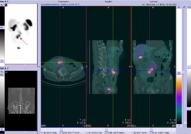 Obr.č.3: Fúze obrazů SPECT a CT – břicho, pánev. Vyšetření 24 hod. po aplikaci radiofarmaka. Zaměřeno na vysoce aktivní ložisko ve střední čáře v mesogastriu ventrálně.