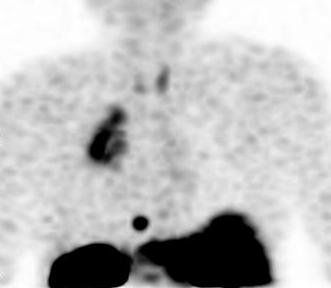 Obr. 1b: Falešně pozitivní nález v plicích 24 hodin po aplikaci Octreoscanu - zadní projekce oblasti plic.