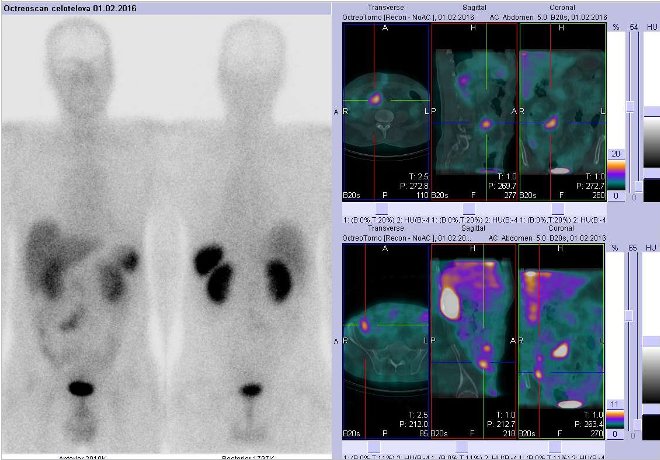 Obr.1: Celotělová scintigrafie a fúze obrazů SPECT a CT. Vpravo nahoře zaměřeno na ložisko v pravém mesogastriu v blízkosti střední čáry a vpravo dole na ložisko v pravém hypogastriu ve střevě. Řez transverzální, sagitální a koronární. Vyšetření 4 hod. po aplikaci OctreoScanu.