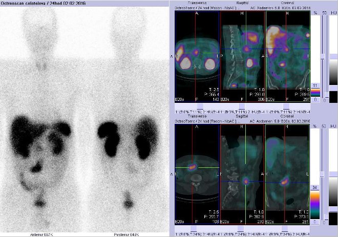 Obr.č.2: Celotělová scintigrafie a fúze obrazů SPECT a CT. Vpravo nahoře zaměřeno na ložisko v epigastriu vpravo v blízkosti střední čáry a vpravo dole na ložisko v pravém mesogastriu v blízkosti střední čáry. Řez transverzální, sagitální a koronární. Vyšetření 24 hod. po aplikaci OctreoScanu.