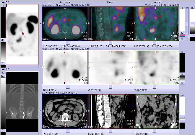 Obr.3: Fúze obrazů SPECT a CT. Zaměřeno na ložisko v epigastriu vpravo v blízkosti střední čáry. Nahoře fúze obrazů, uprostřed SPECT, dole CT. Řezy transverzální, sagitální a koronární. Vyšetření 24 hod. po aplikaci OctreoScanu.