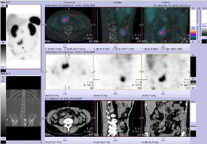 Obr. č. 5: Fúze obrazů SPECT a CT. Zaměřeno na ložisko v pravém mesogastriu v blízkosti střední čáry. Nahoře fúze obrazů, uprostřed SPECT, dole CT. Řezy transverzální, sagitální a koronární. Vyšetření 24 hod. po aplikaci OctreoScanu.