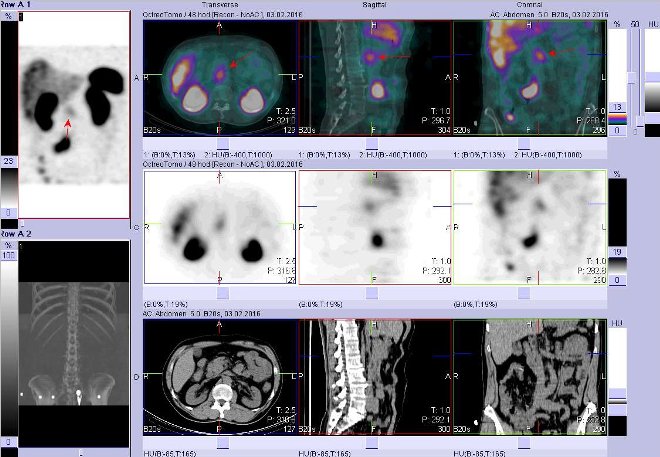 Obr. č. 7: Fúze obrazů SPECT a CT. Zaměřeno na ložisko v epigastriu vpravo v blízkosti střední čáry. Nahoře fúze obrazů, uprostřed SPECT, dole CT. Řezy transverzální, sagitální a koronární. Vyšetření 48 hod. po aplikaci OctreoScanu.