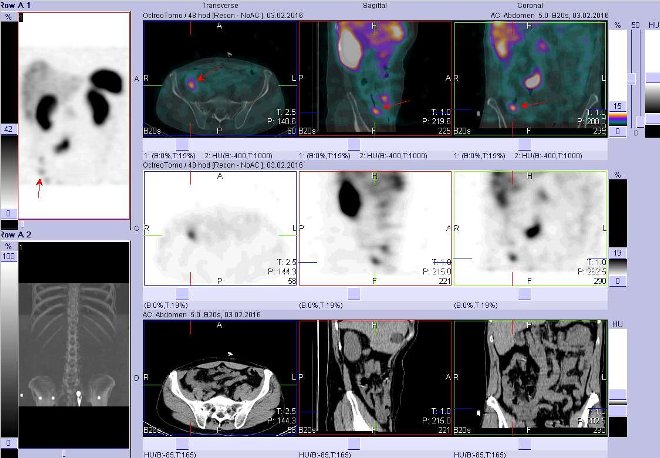 Obr. č. 9: Fúze obrazů SPECT a CT. Zaměřeno na ložisko v pravém hypogastriu ve střevě. Nahoře fúze obrazů, uprostřed SPECT, dole CT. Řezy transverzální, sagitální a koronární. Vyšetření 48 hod. po aplikaci OctreoScanu.