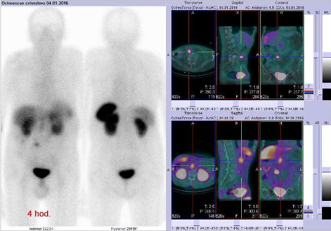 Obr.č.1: Celotělová scintigrafie v přední a zadní projekci a fúze obrazů SPECT a CT. Zaměřeno na dvě ložiska – jedno v pravém mesogastriu v blízkosti střední čáry nejspíše se nacházející ve střevě, druhé ložisko se promítá do epigastria, je v hloubce vpravo paraaortálně (v pankreatu? v uzlině?). Vyšetření 4 hod. po aplikaci radioindikátoru.