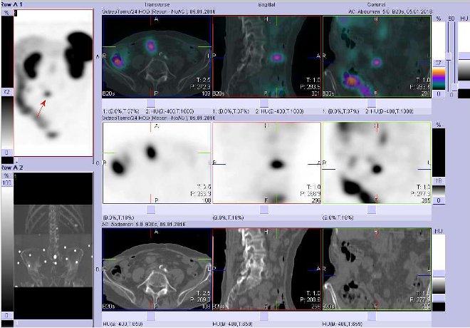 Obr. č. 3: Fúze obrazů SPECT a CT. Zaměřeno na ložisko v pravém mesogastriu v blízkosti střední čáry nejspíše se nacházející ve střevě. Vyšetření 24 hod. po aplikaci radioindikátoru.