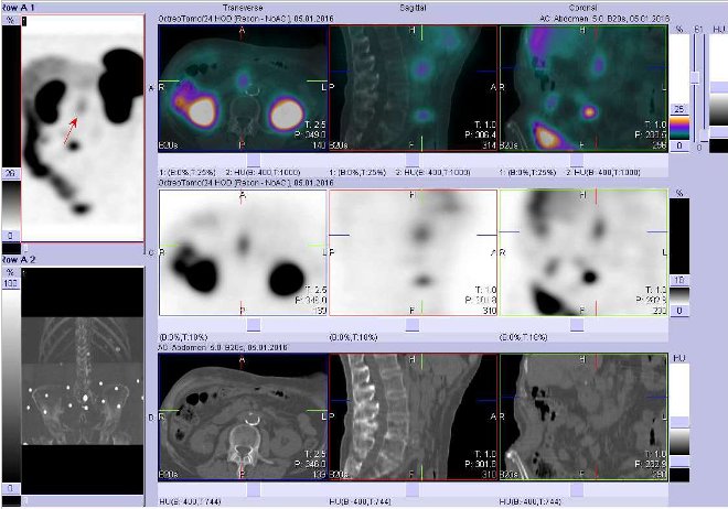 Obr.č.4: Fúze obrazů SPECT a CT. Zaměřeno na ložisko promítající se do epigastria, je v hloubce vpravo paraaortálně (v pankreatu? v uzlině?).  Vyšetření 24 hod. po aplikaci radioindikátoru.