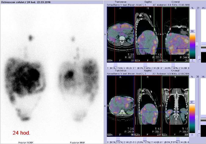 Obr. č. 4: Celotělová scintigrafie v přední a zadní projekci a fúze obrazů SPECT a CT. Zaměřeno na metastázu ve ventrální a další ložisko v dorzální části pravého jaterního laloku. Vyšetření 24 hod. po aplikaci radioindikátoru.