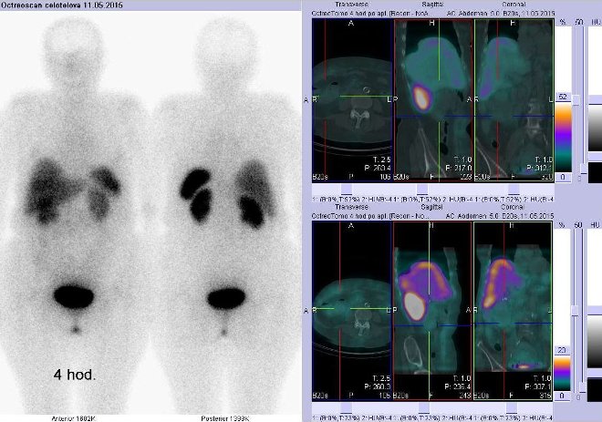 Obr. č. 5: Celotělová scintigrafie v přední a zadní projekci a fúze SPECT/CT 4 hod. po aplikaci OctreoScanu. Zaměřeno na pravé mesogastrium.