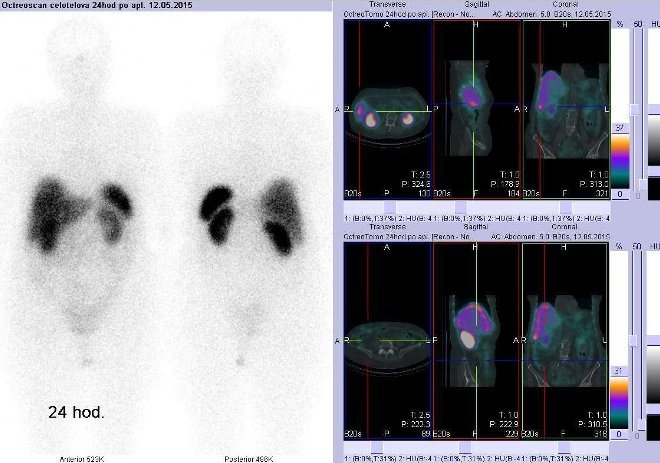 Obr. č. 6: Celotělová scintigrafie v přední a zadní projekci a fúze SPECT/CT 24 hod. po aplikaci OctreoScanu. Zaměřeno na dolní část pravého jaterního laloku (vpravo nahoře) a na pravé mesogastrium (vpravo dole).
