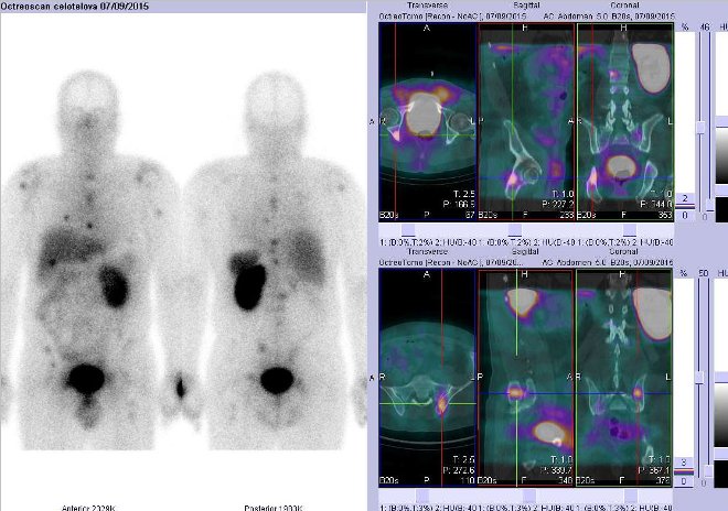 Obr. č. 3: Celotělová scintigrafie v přední a zadní projekci a fúze obrazů SPECT a CT. Vyšetření 4 hod. po aplikaci radioindikátoru. Zaměřeno na ložisko v levé části pánve těsně pod acetabulem a na ložisko v lopatě pravé kosti kyčelní v blízkosti pravého SI skloubení.