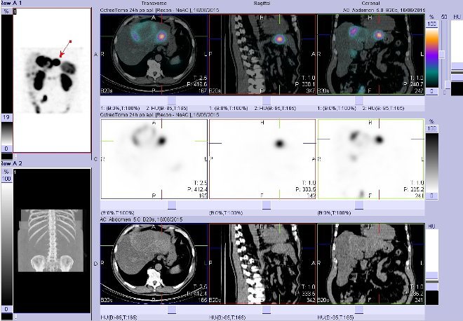 Obr. č. 11: Fúze obrazů SPECT a CT – vyšetření břicha. Vyšetření 24 hod. po aplikaci radiofarmaka. Vpravo nahoře fúze SPECT a CT, vlevo uprostřed SPECT, vlevo dole CT. Zaměřeno na ložisko v levém jaterním laloku.