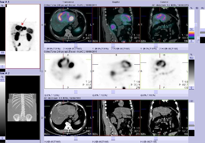 Obr. č. 12: Fúze obrazů SPECT a CT – vyšetření břicha. Vyšetření 24 hod. po aplikaci radiofarmaka. Vpravo nahoře fúze SPECT a CT, vlevo uprostřed SPECT, vlevo dole CT. Zaměřeno na ložisko v pravém jaterním laloku.