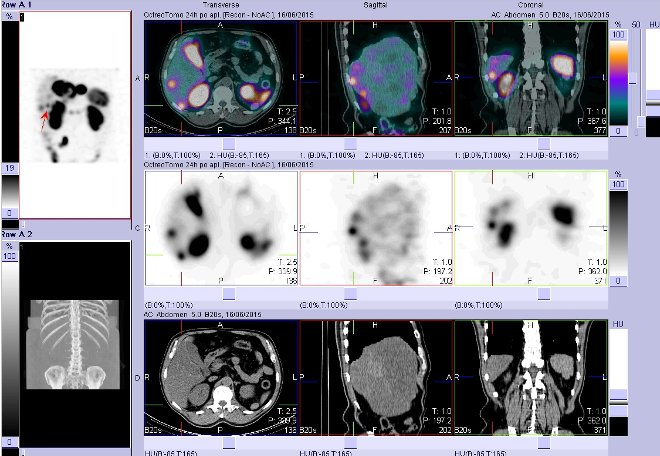 Obr. č. 13: Fúze obrazů SPECT a CT – vyšetření břicha. Vyšetření 24 hod. po aplikaci radiofarmaka. Vpravo nahoře fúze SPECT a CT, vlevo uprostřed SPECT, vlevo dole CT. Zaměřeno na ložisko v pravém jaterním laloku.