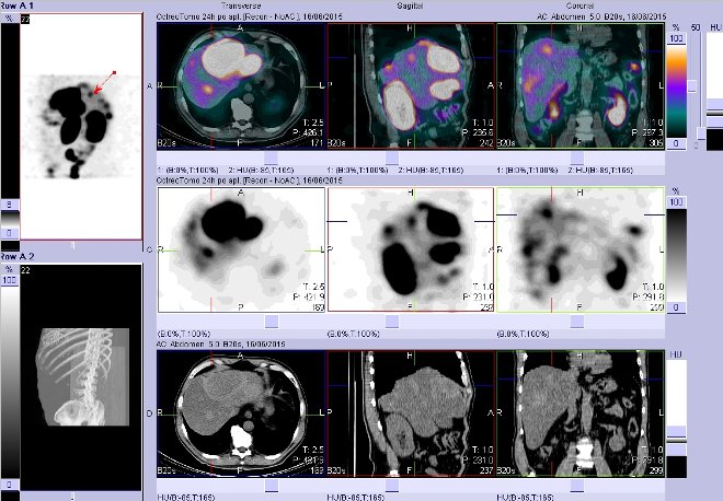 Obr. č. 14: Fúze obrazů SPECT a CT – vyšetření břicha. Vyšetření 24 hod. po aplikaci radiofarmaka. Vpravo nahoře fúze SPECT a CT, vlevo uprostřed SPECT, vlevo dole CT. Zaměřeno na ložisko v pravém jaterním laloku.