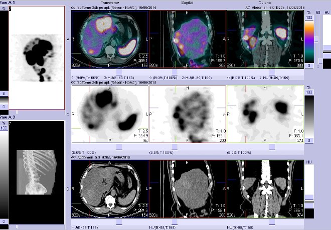 Obr. č. 15: Fúze obrazů SPECT a CT – vyšetření břicha. Vyšetření 24 hod. po aplikaci radiofarmaka. Vpravo nahoře fúze SPECT a CT, vlevo uprostřed SPECT, vlevo dole CT. Zaměřeno na ložisko v pravém jaterním laloku.